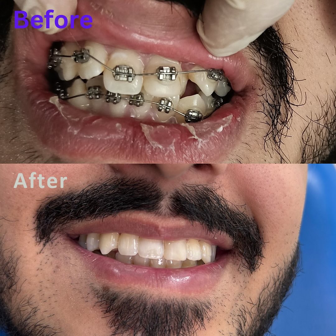 Before-and-after braces photographs from Dr Awais Afridi’s Instagram