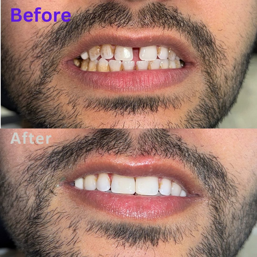 Before-and-after smile photographs from Dr Awais Afridi’s Instagram